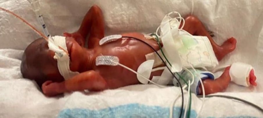 अमेरिकामा एक पाउन्डभन्दा कम जन्मिएका शिशुलाई विश्वमै कम समयमा जन्मिने जीवित शिशुका रूपमा प्रमाणित